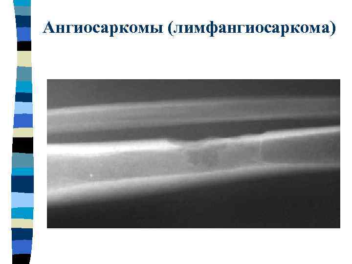 Ангиосаркомы (лимфангиосаркома) 