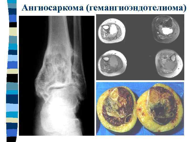 Злокачественная фиброзная гистиоцитома фото