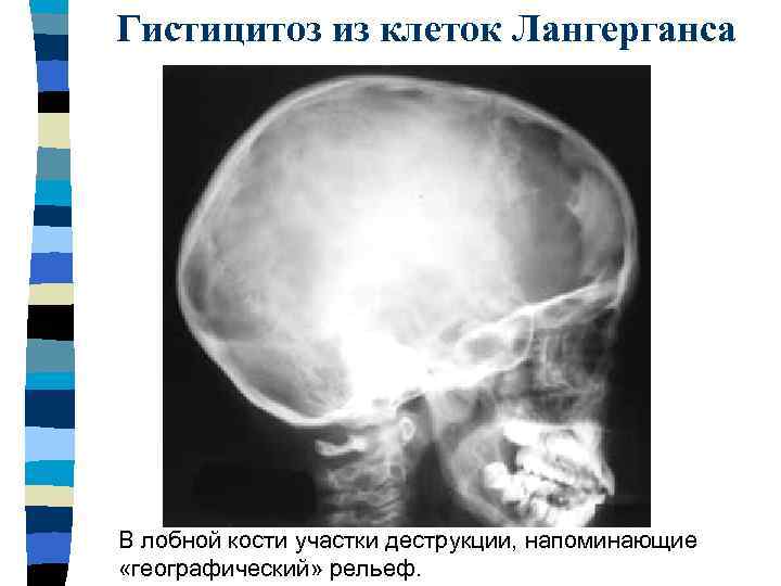 Гистицитоз из клеток Лангерганса В лобной кости участки деструкции, напоминающие «географический» рельеф. 