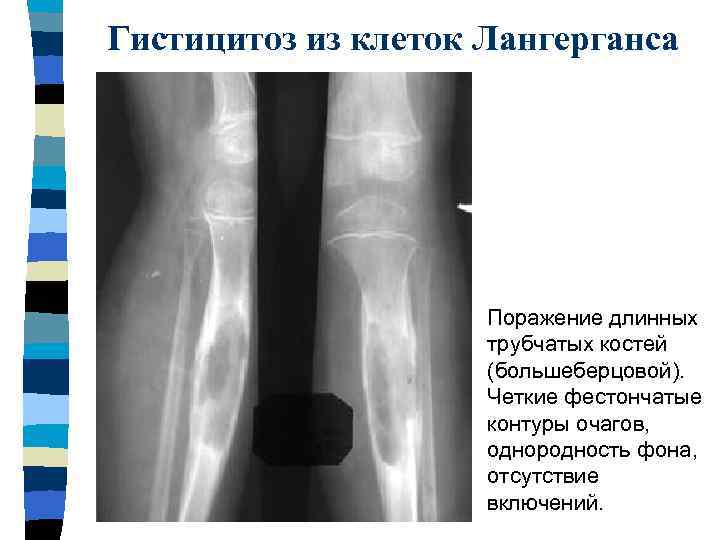 Первичные злокачественные опухоли костей особенности рентгеновской картины