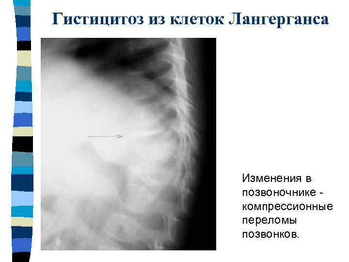 Гистицитоз из клеток Лангерганса Изменения в позвоночнике компрессионные переломы позвонков. 