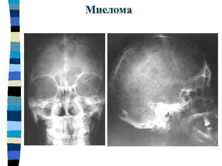 Миелома 