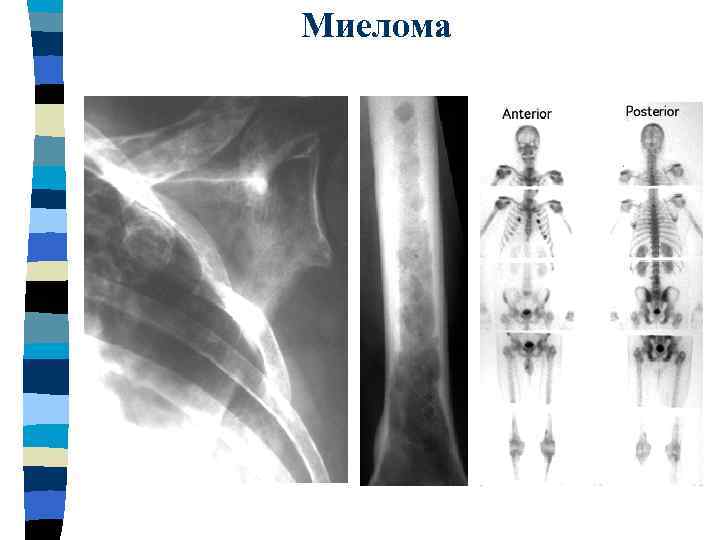 Миелома 