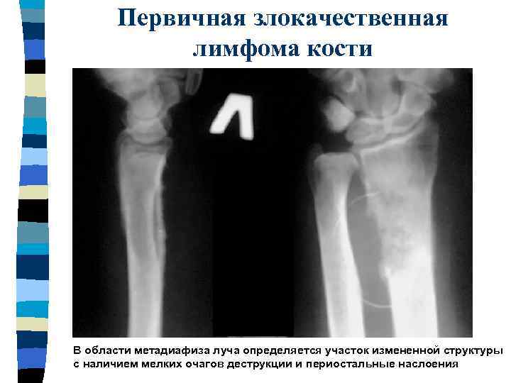 Первичные злокачественные опухоли костей