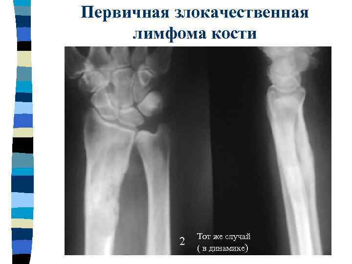 Первичная злокачественная лимфома кости 2 Тот же случай ( в динамике) 