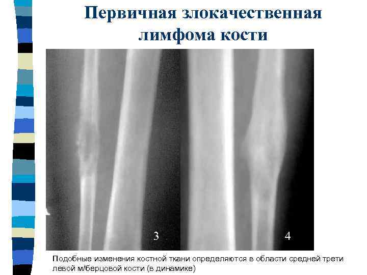 Первичные злокачественные опухоли костей особенности рентгеновской картины