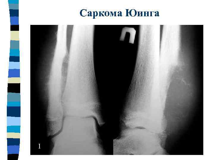 Саркома юинга симптомы