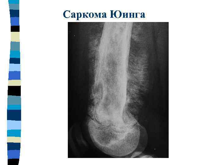 Чем отличается саркома. Остеосаркома кости рентген. Рентгенологические симптомы саркомы Юинга.