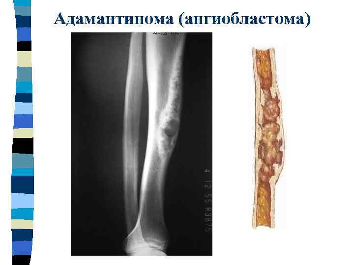 Адамантинома (ангиобластома) 