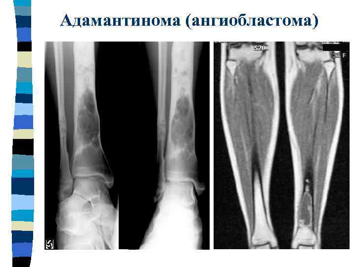 Адамантинома (ангиобластома) 