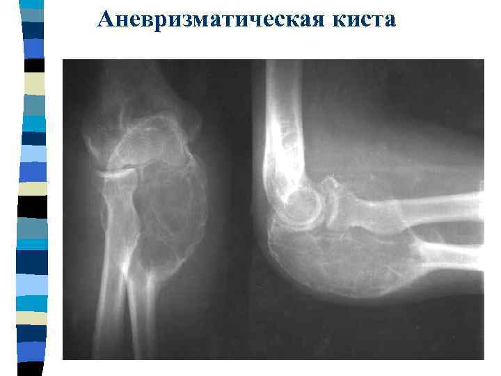 Аневризматическая киста 