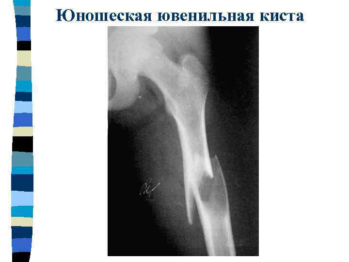 Юношеская ювенильная киста 