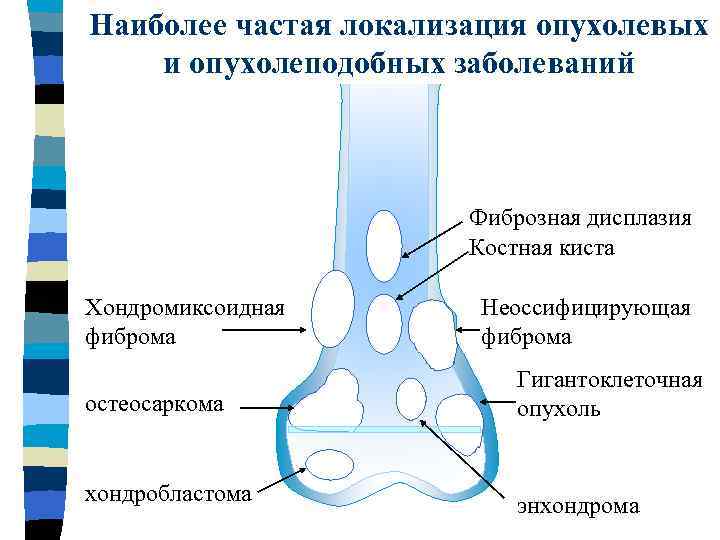 Опухоли костей схема