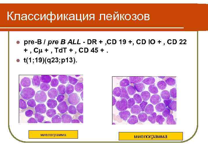 Лимфобластный лейкоз. Пре-пре-острый лимфобластный лейкоз. B лимфобластный лейкоз. Классификация лейкозов у детей. Лимфобластный лейкоз миелограмма.