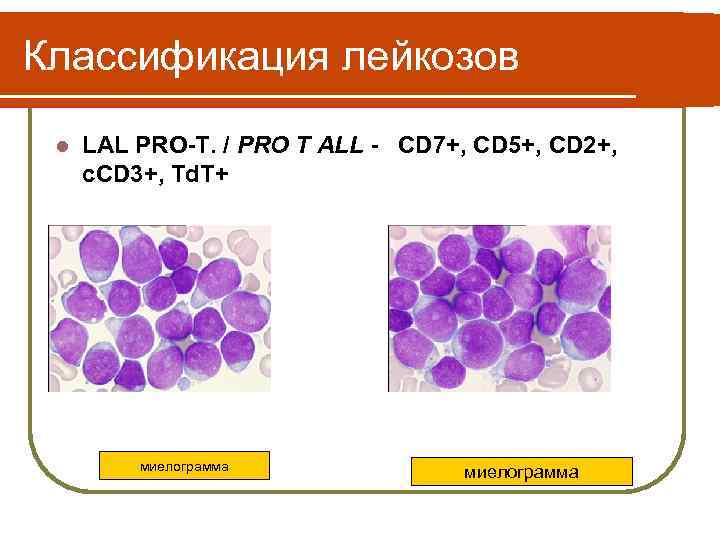 Классификация лейкозов l LAL PRO-T. / PRO T ALL - CD 7+, CD 5+,
