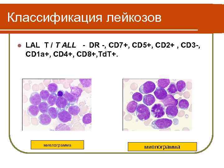 Лимфобластный лейкоз у детей прогноз. Лимфобластный лейкоз классификация. Лимфобластный лейкоз миелограмма. Классификация лейкозов. Классификация лимфобластного лейкоза.