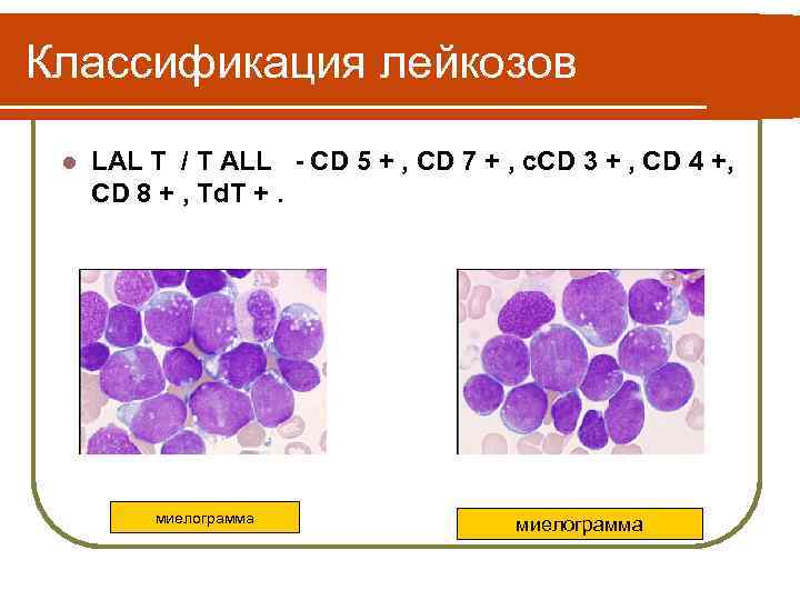 Острый лимфобластный лейкоз клинические рекомендации у детей. Лимфобластный лейкоз миелограмма. Острый лейкоз миелограмма. Миелограмма при остром лейкозе. Миелограмма при остром лейкозе у детей.