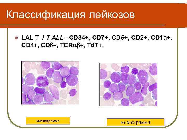 Классификация лейкозов l LAL T / T ALL - CD 34+, CD 7+, CD