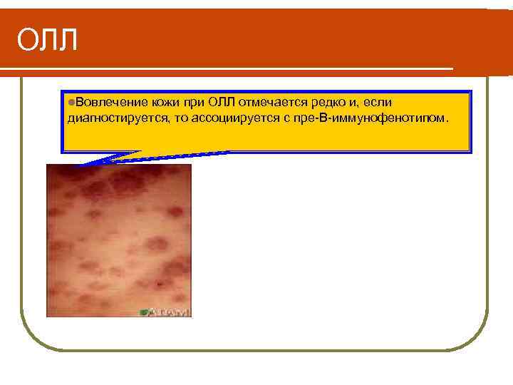 ОЛЛ l. Вовлечение кожи при ОЛЛ отмечается редко и, если диагностируется, то ассоциируется с