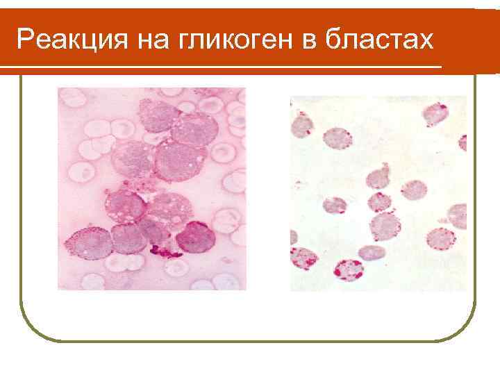 Реакция на гликоген в бластах 