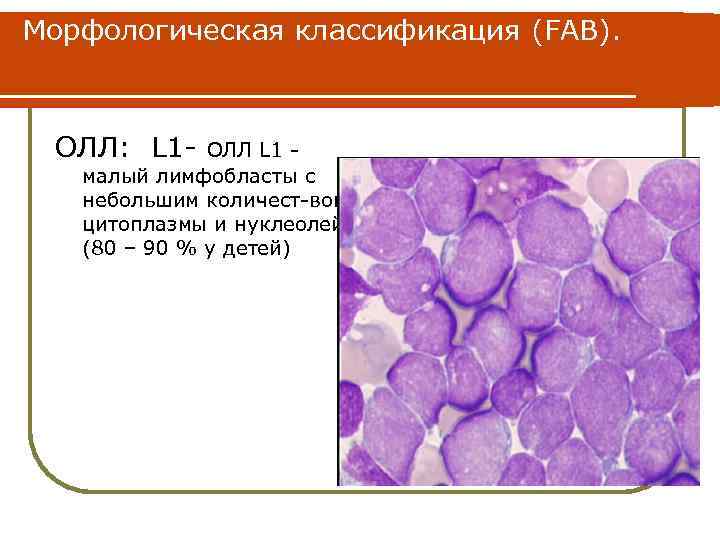 Острый лимфобластный лейкоз. Острый лимфобластный лейкоз пролимфоциты. Острый лимфобластный лейкоз у детей. Морфологические особенности лимфобласта. Характеристика лимфобласта.