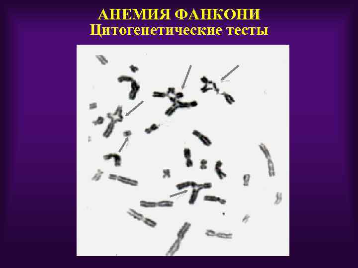 АНЕМИЯ ФАНКОНИ Цитогенетические тесты 