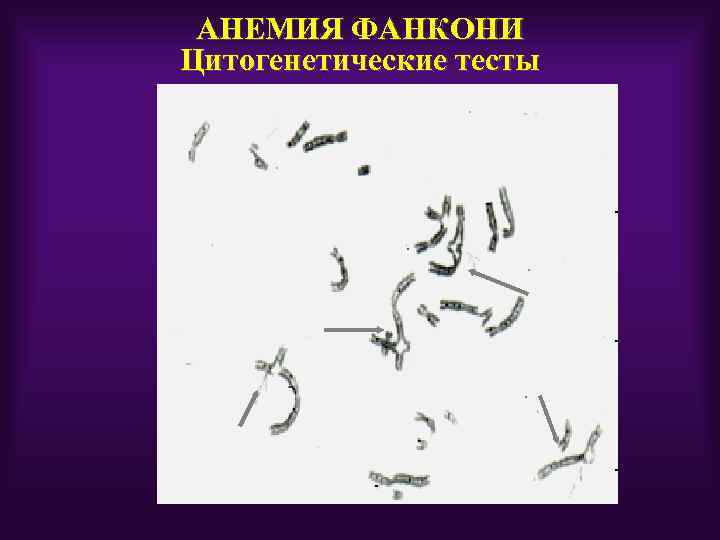 АНЕМИЯ ФАНКОНИ Цитогенетические тесты 