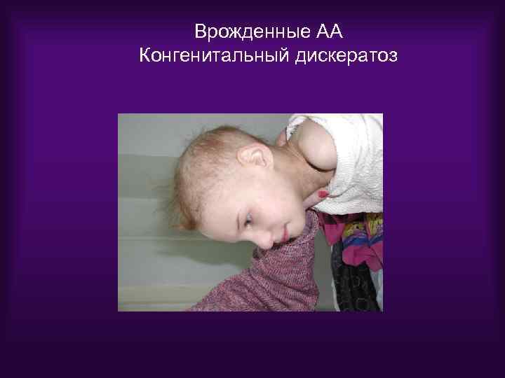 Врожденные АА Конгенитальный дискератоз 