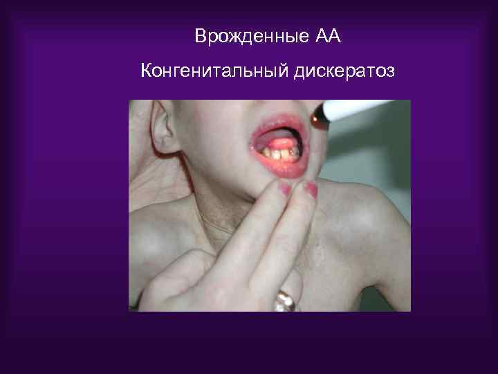 Врожденные АА Конгенитальный дискератоз 