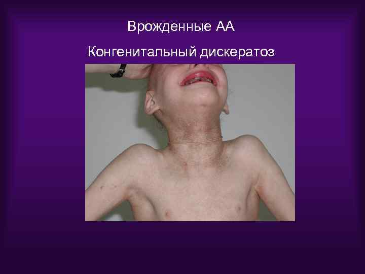 Врожденные АА Конгенитальный дискератоз 