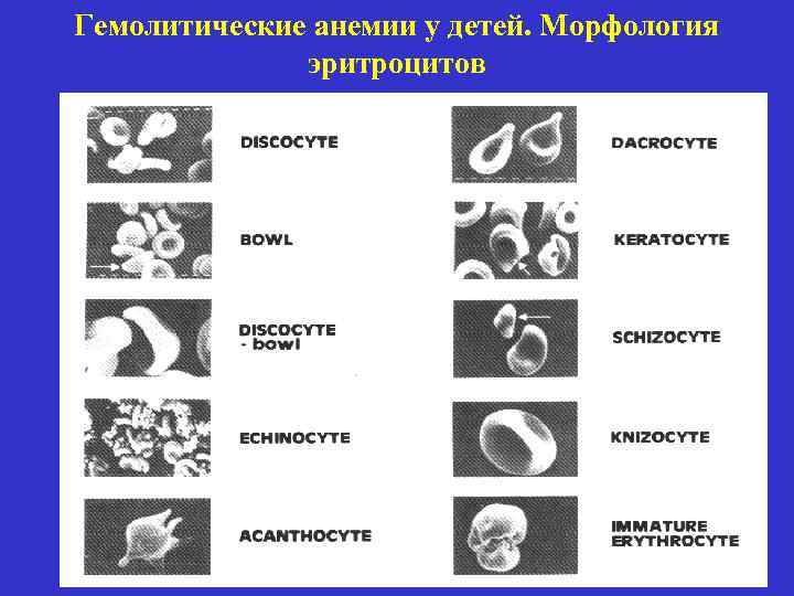 Гемолитические анемии у детей. Морфология эритроцитов 