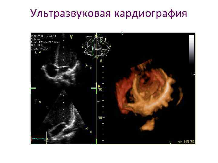 Ультразвуковая кардиография 