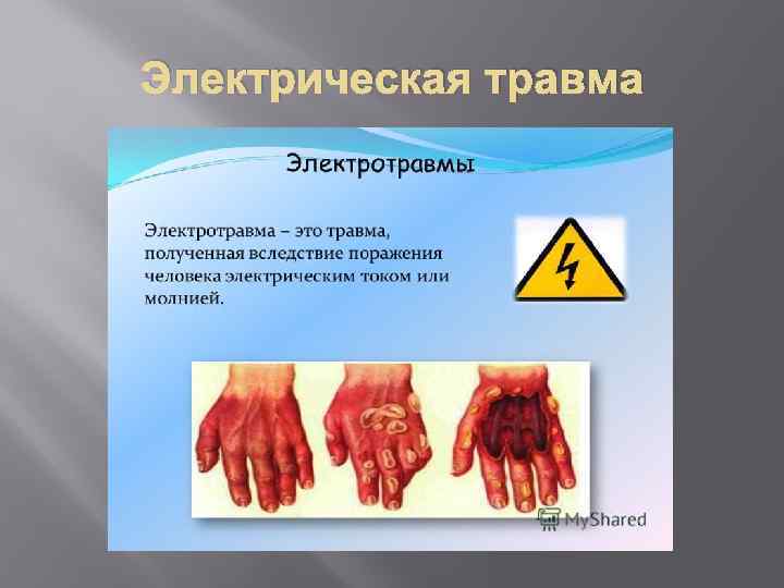 Электрическая травма 