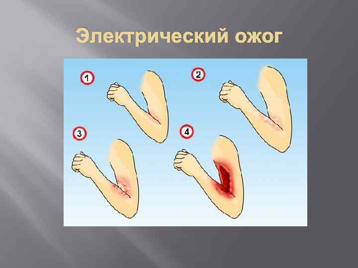Электрический ожог 