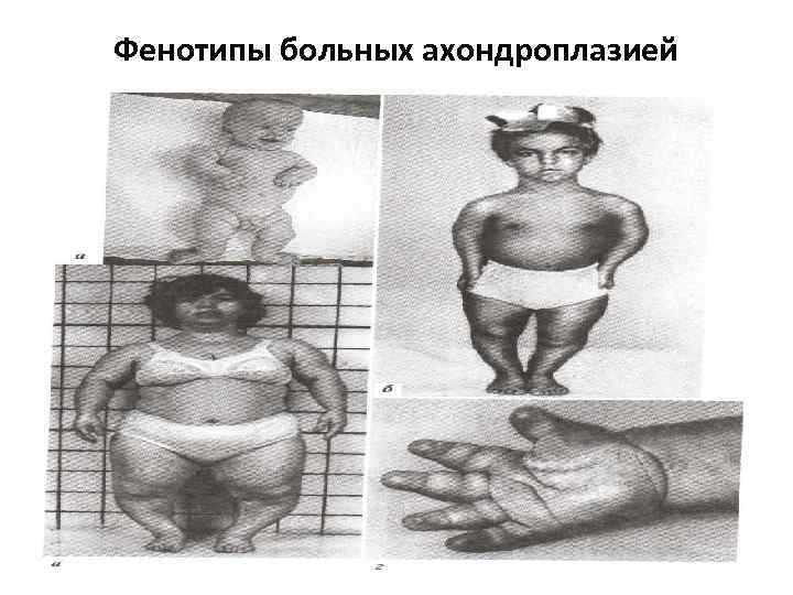 Фенотипы больных ахондроплазией 