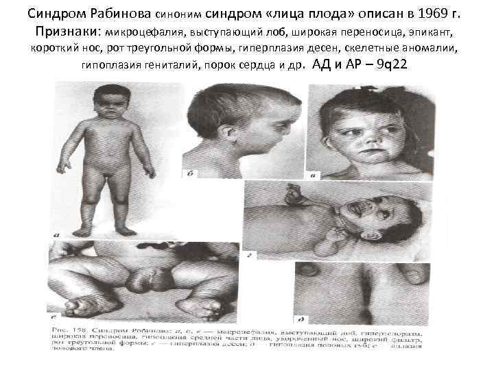 Синдром Рабинова синоним синдром «лица плода» описан в 1969 г. Признаки: микроцефалия, выступающий лоб,