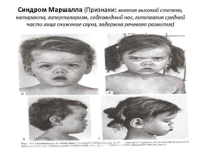Синдром Маршалла (Признаки: миопия высокой степени, катаракта, гипертелоризм, седловидный нос, гипоплазия средней части лица