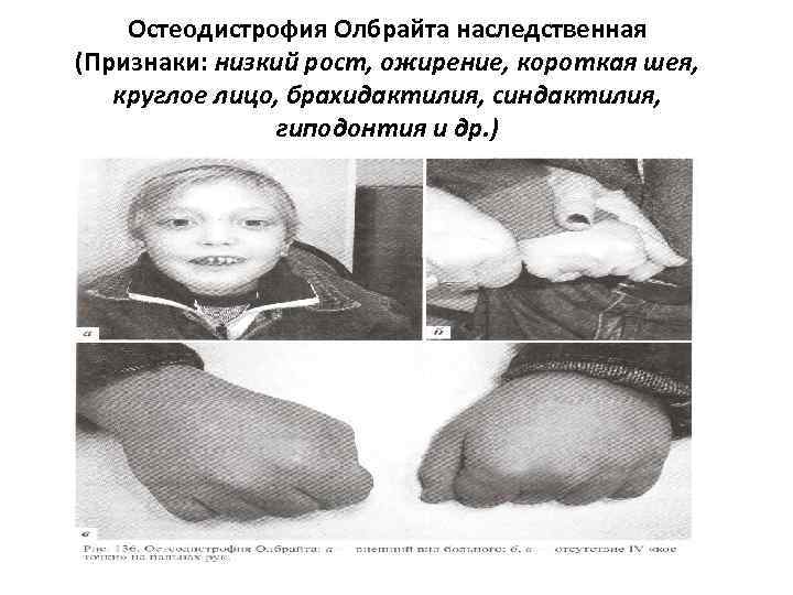 Остеодистрофия Олбрайта наследственная (Признаки: низкий рост, ожирение, короткая шея, круглое лицо, брахидактилия, синдактилия, гиподонтия