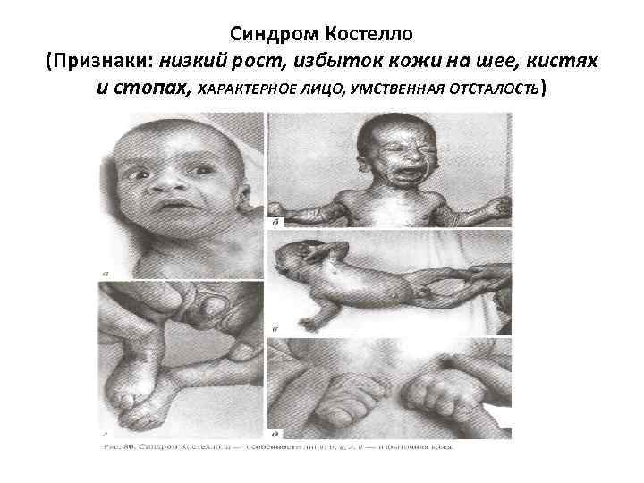 Синдром Костелло (Признаки: низкий рост, избыток кожи на шее, кистях и стопах, ХАРАКТЕРНОЕ ЛИЦО,