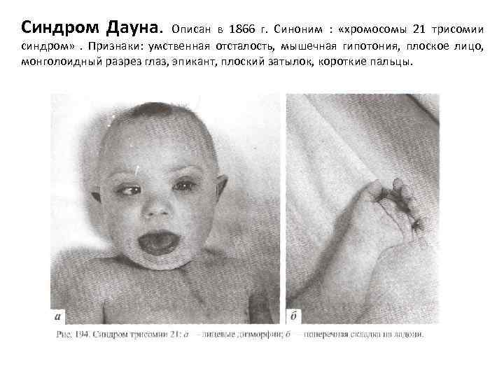 Синдром Дауна. Описан в 1866 г. Синоним : «хромосомы 21 трисомии синдром» . Признаки: