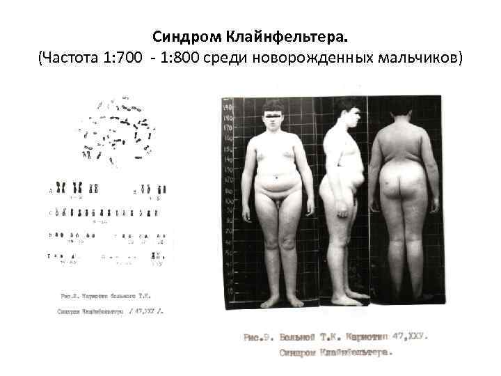 Синдром Клайнфельтера. (Частота 1: 700 - 1: 800 среди новорожденных мальчиков) 