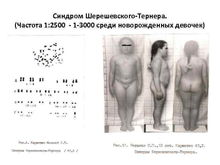 Синдром Шерешевского-Тернера. (Частота 1: 2500 - 1 -3000 среди новорожденных девочек) 