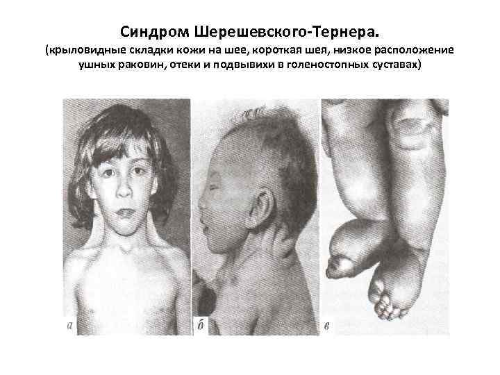 Синдром Шерешевского-Тернера. (крыловидные складки кожи на шее, короткая шея, низкое расположение ушных раковин, отеки