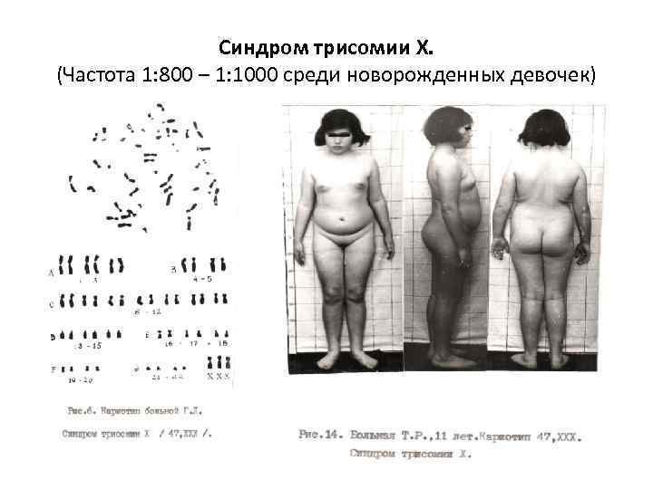 Синдром трисомии Х. (Частота 1: 800 – 1: 1000 среди новорожденных девочек) 