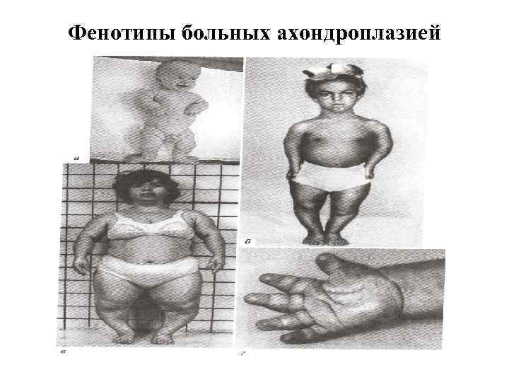 Фенотипы больных ахондроплазией 