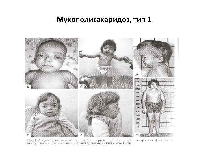 Мукополисахаридоз, тип 1 