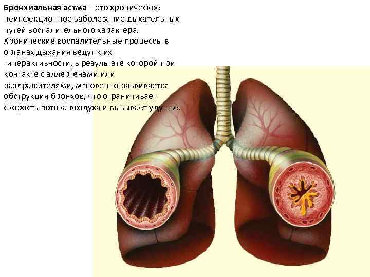 Бронхиальная астма – это хроническое неинфекционное заболевание дыхательных путей воспалительного характера. Хронические воспалительные процессы