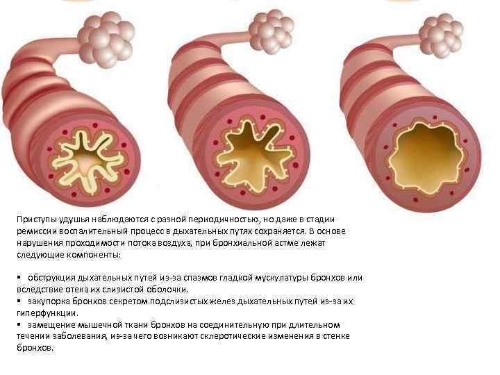 Приступы удушья наблюдаются с разной периодичностью, но даже в стадии ремиссии воспалительный процесс в