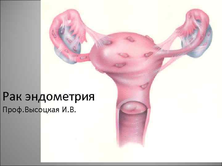 Рак эндометрия Проф. Высоцкая И. В. 