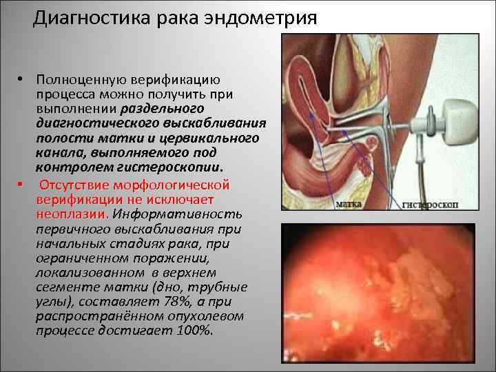 Диагностика рака эндометрия • Полноценную верификацию процесса можно получить при выполнении раздельного диагностического выскабливания